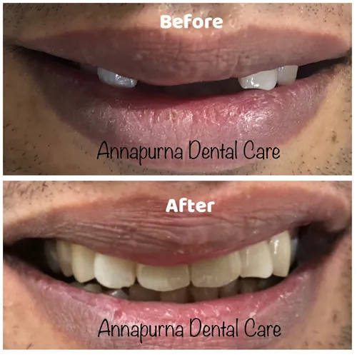 Aesthetic Zirconia Crown Case 18 - Annapurna Dental Care